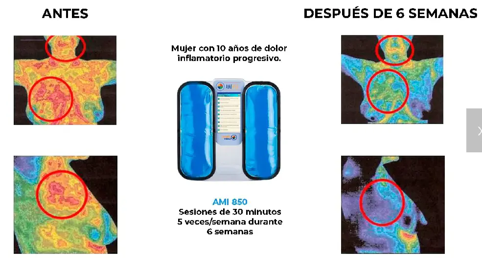 Registro termográfico antes y después de seis semanas de sesiones de Cimaterapia
